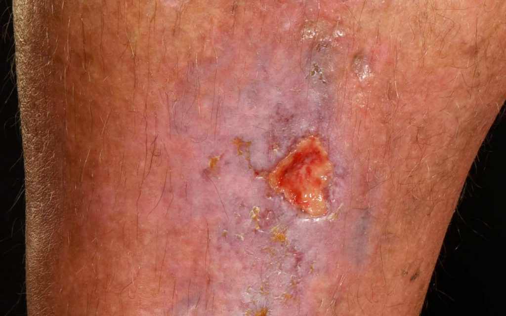 What a leg ulcer looks like