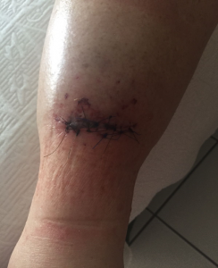 Simple laceration showing mild oedema