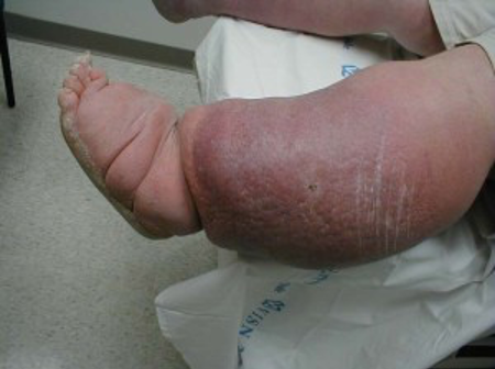 Moderate oedema