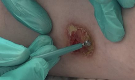 Sharp Debridement over a wound