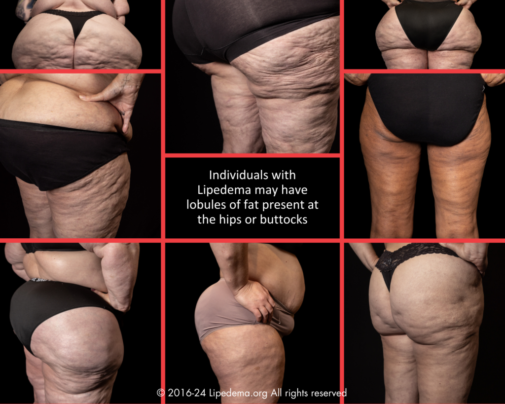 Various examples of legs showing lipoedema